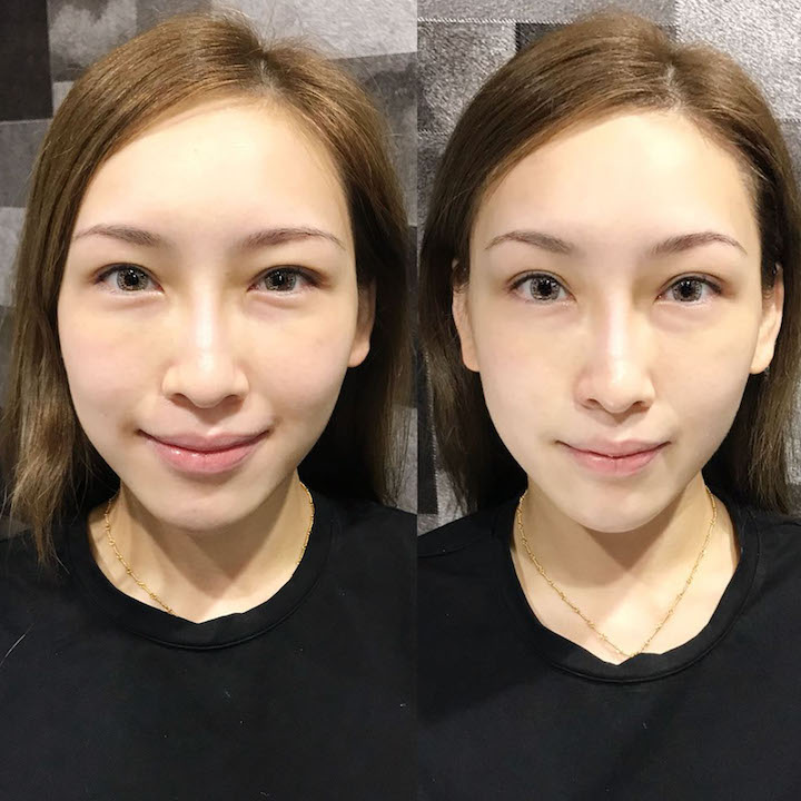 PrincessBrow HIFU Magic V Lift