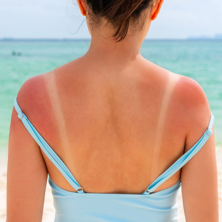 skin central sunburn sun safety skin cancer check hong kong